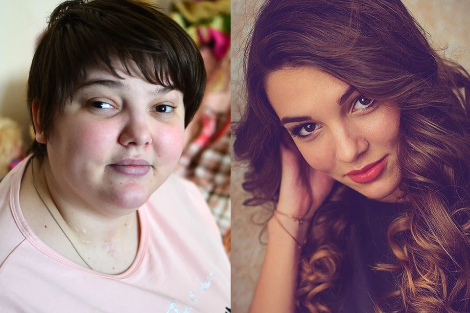 После аварии Маша стала выглядеть совсем по-другому (слева - сейчас, справа - до аварии). Фото: Влад КОМЯКОВ и instagram.com/mashulka_lebedeva