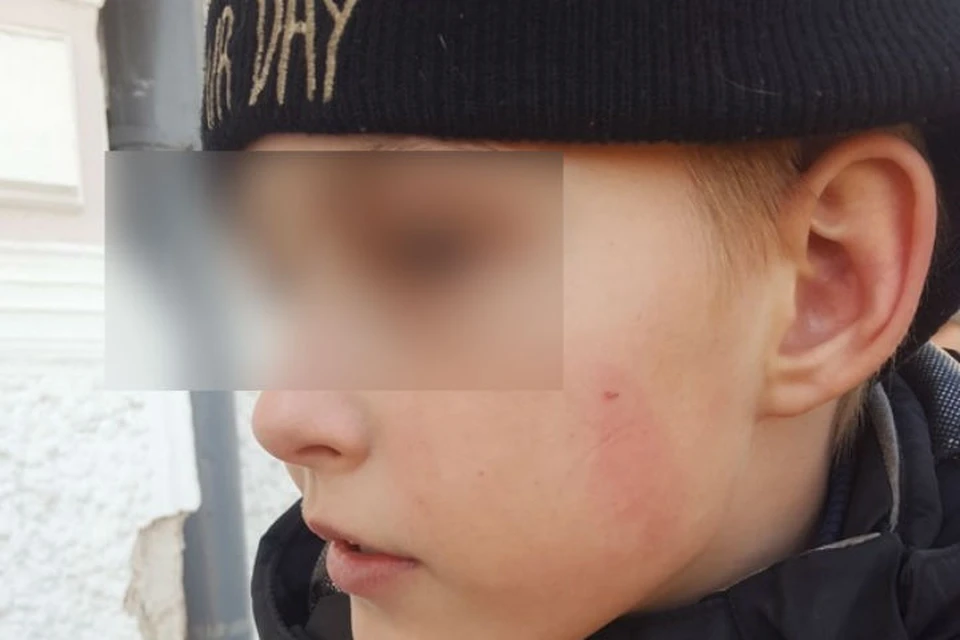После удара у пострадавшего ребенка осталась ссадина на лице. Фото предоставлено мамой школьника.