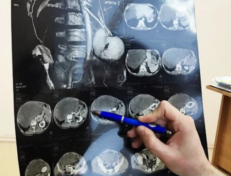 В Кемерове врачи удалили 71-летнему пациенту опухоль весом более 7 килограммов. Фото: instagram/onkologykuzbass/.