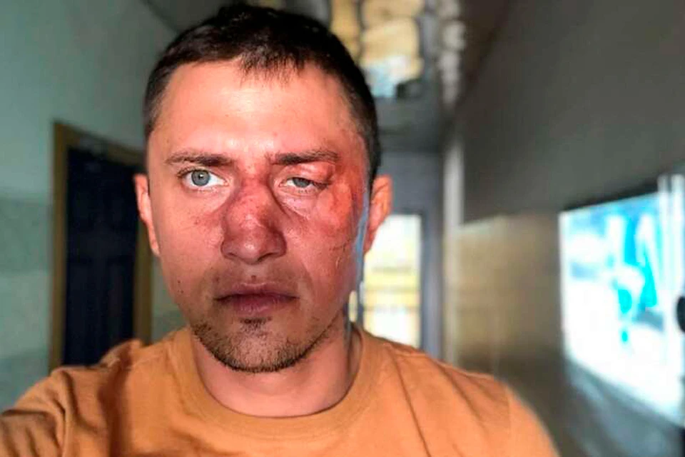 Актер Павел Прилучный опубликовал в Instagram фото со следами избиения на лице.