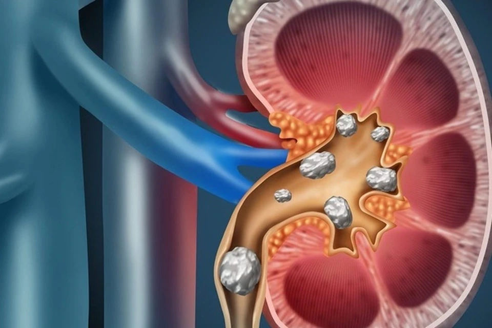 Камни в почках у женщин фото В Севастополе появилось новейшее оборудование для диагностики и лечения мочекаме