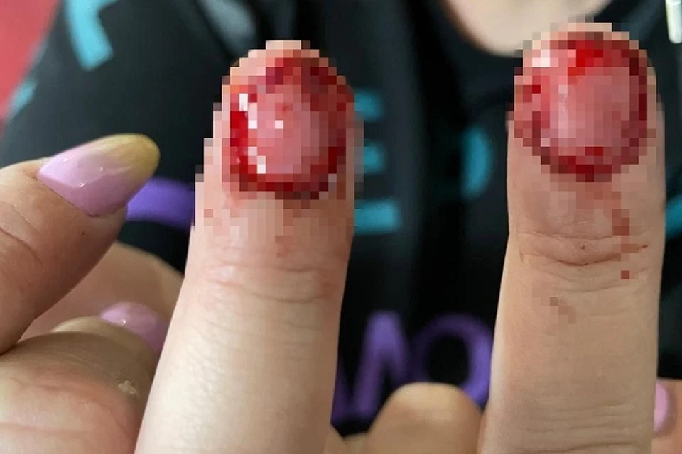 Юлии вырвали два ногтя, когда отбирали телефон в полицейском участке. Фото: предоставлено КП