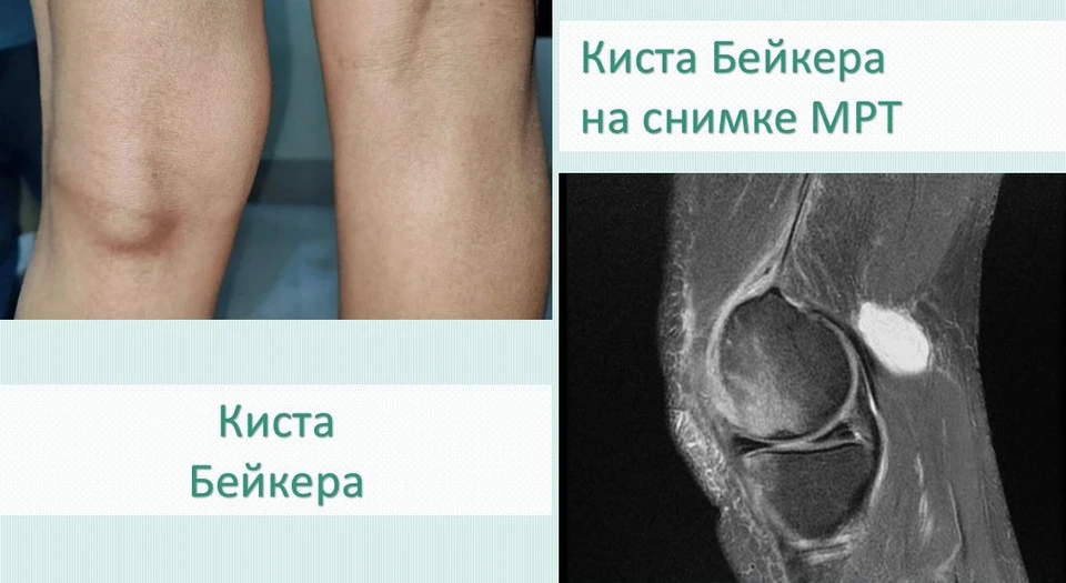 Киста Бейкера представляет собой скопление жидкости в подколенной ямке и может развиваться бессимптомно. Фото: Минздрав