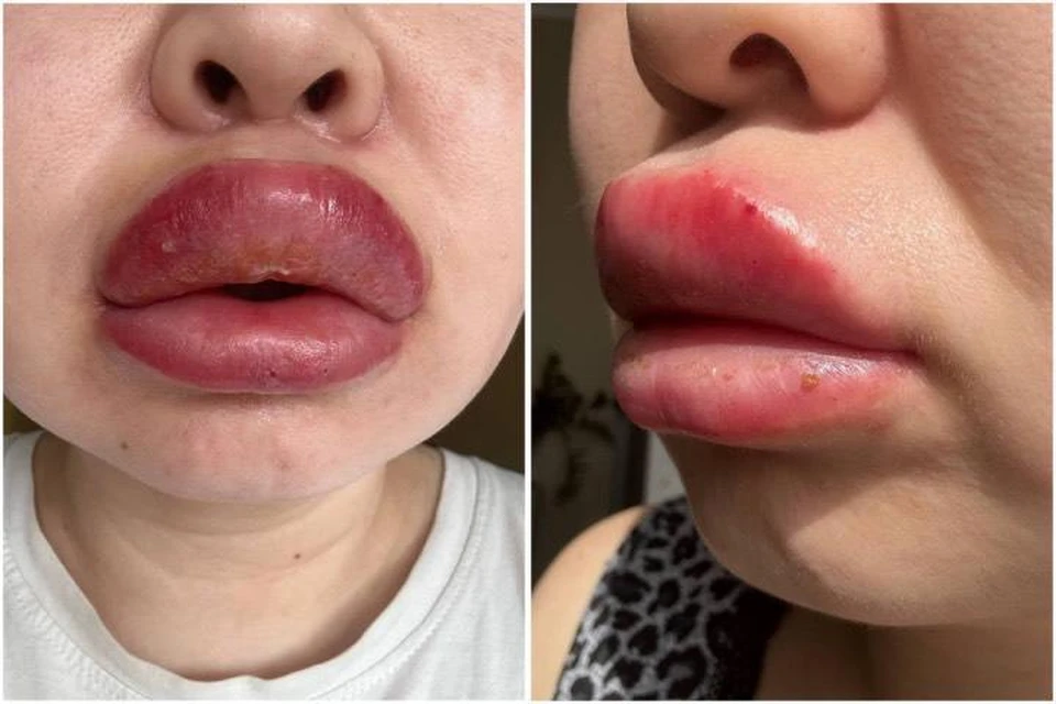Сибирячка до сих пор не может улыбаться нормально. Фото: предоставлено пострадавшей девушкой.