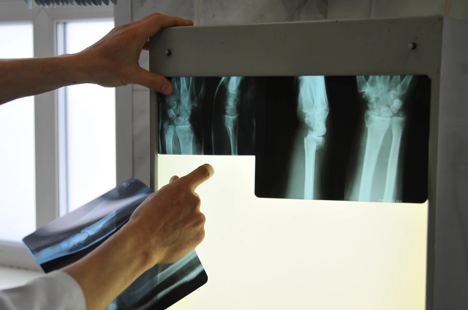 Новосибирские ученые предложили способ предотвращения переломов при остеопорозе