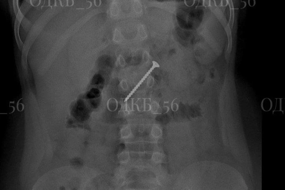 На рентгене брюшной полости, выполненном в районной больнице, действительно обнаружили металлический предмет. Фото: ОДКБ56