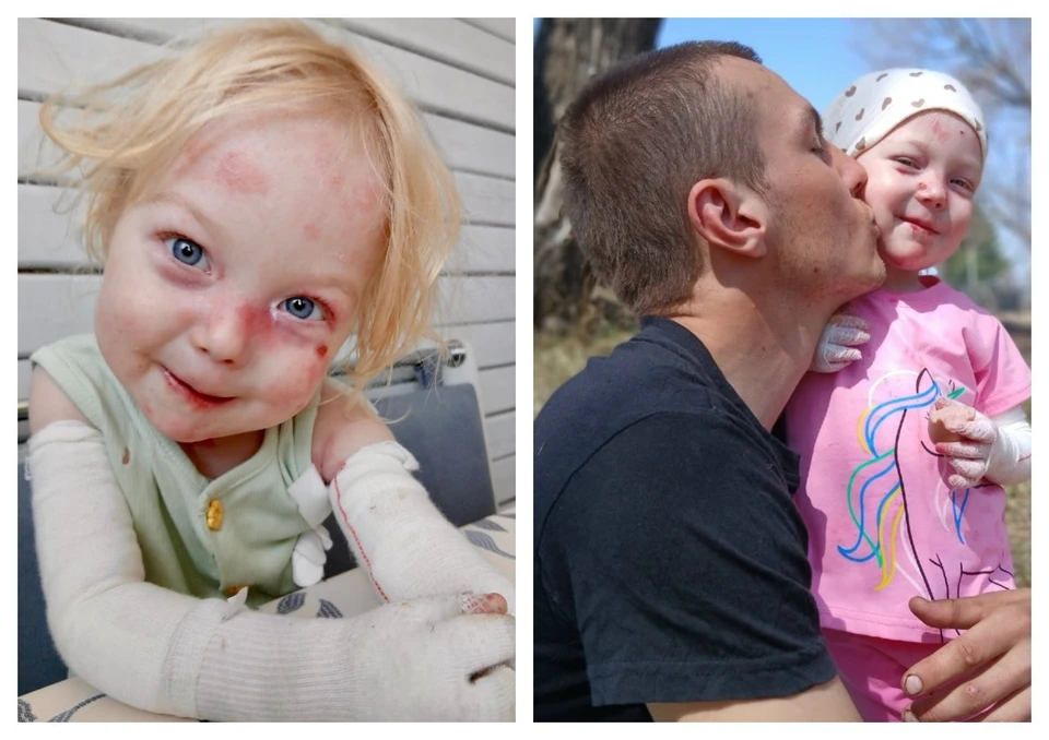 3-летней девочке с синдромом бабочки требуется помощь в Шелеховском районе. Фото: личный архив.