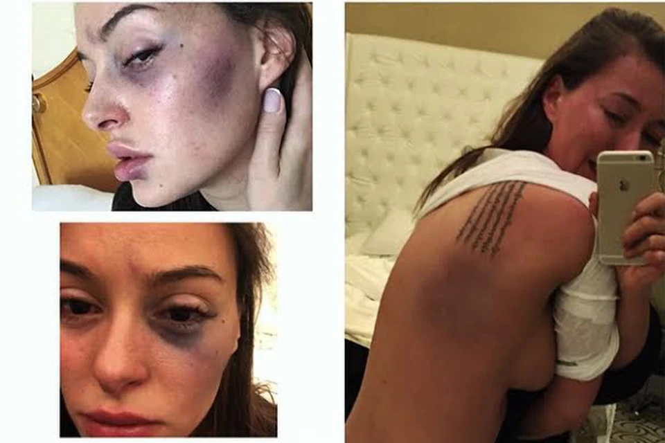 Экс-участница "Хочу в ВИА Гру" выложила в Инстаграм шокирующие снимки
