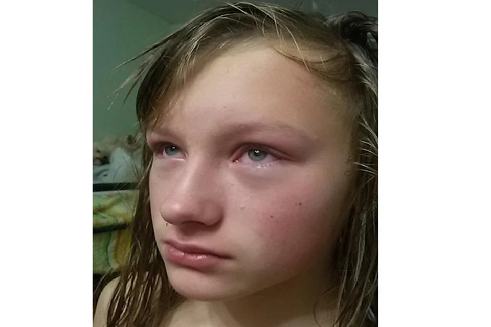 Повреждения на теле девочки (ожоги сетчатки, ссадины и ушибы) нанесла мама одного мальчика. Фото: соцсети