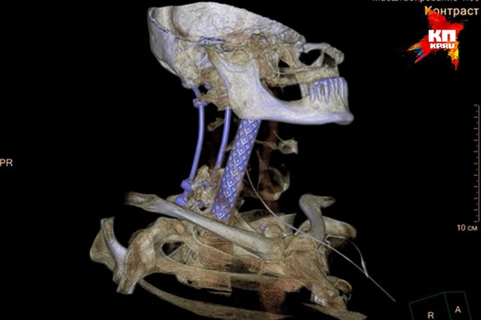 Вместо шейных позвонков теперь у пациента стоит титановая трубка.
