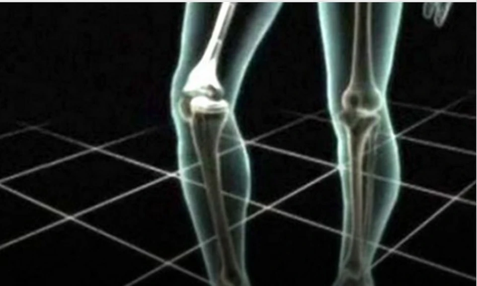 Наши ученые создали имплант, сращивающий после переломов кости за месяц.