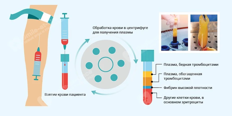 Как лечить воспаление десен?