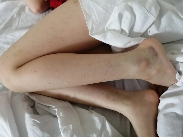 О каких болезнях говорят спонтанно появляющиеся синяки на ногах